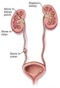 causes of kidney stones