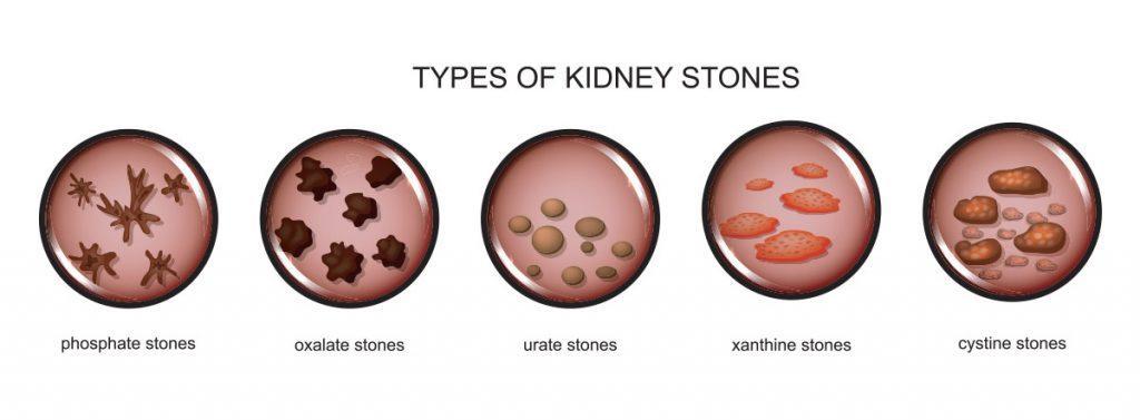 kidney stones treatment in Melbourne